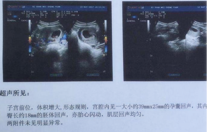 关于B超孕囊形状判断男女的问题