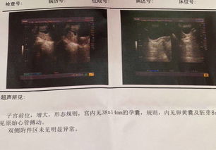 香港验血和5个月B超一致(香港八周验血是男孩,四个月做bc说.)