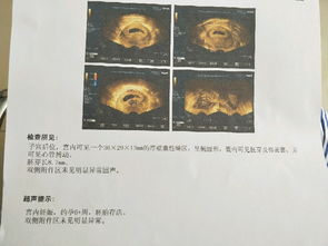 香港验血未验出y可能会是儿子吗(有没有检测不到y染色体却) 