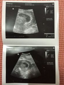 香港验血回来还有B超的吗(香港康盈基因检测中心验血是男的